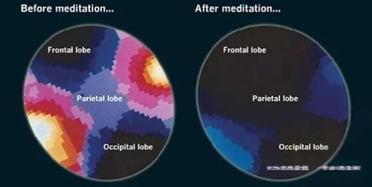 Meditation Benefits: How meditation Practice Transforms Your Brain